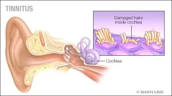 Tinnitus Treatment in Lahore and Pure Tone Audiometry Test Price